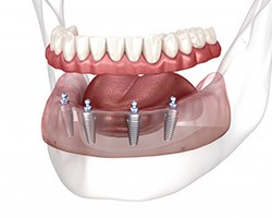 Illustration of all-on-4 dentures