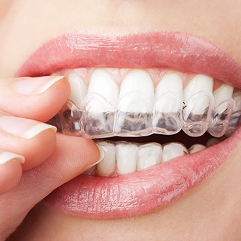 A closeup of a mouth placing a teeth whitening tray